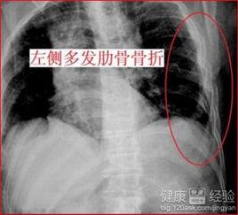 肋骨骨折可以吃瓜吗,瓜类食物的适宜与否