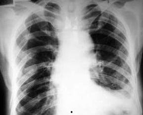 肋骨骨折可以吃瓜吗,瓜类食物的适宜与否